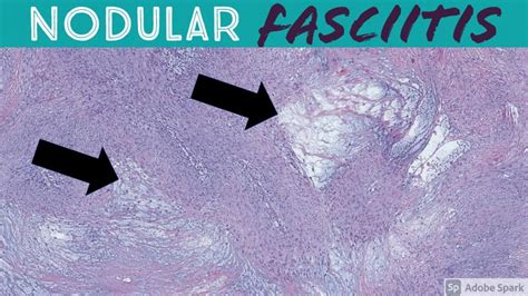 Nodular Fasciitis: Pathology, Causes & Treatment